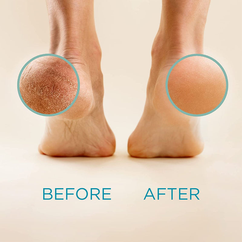 Beautique™ Callus Remover